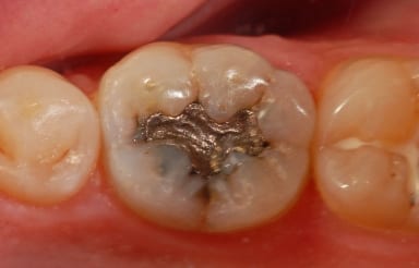 intraoral_picture